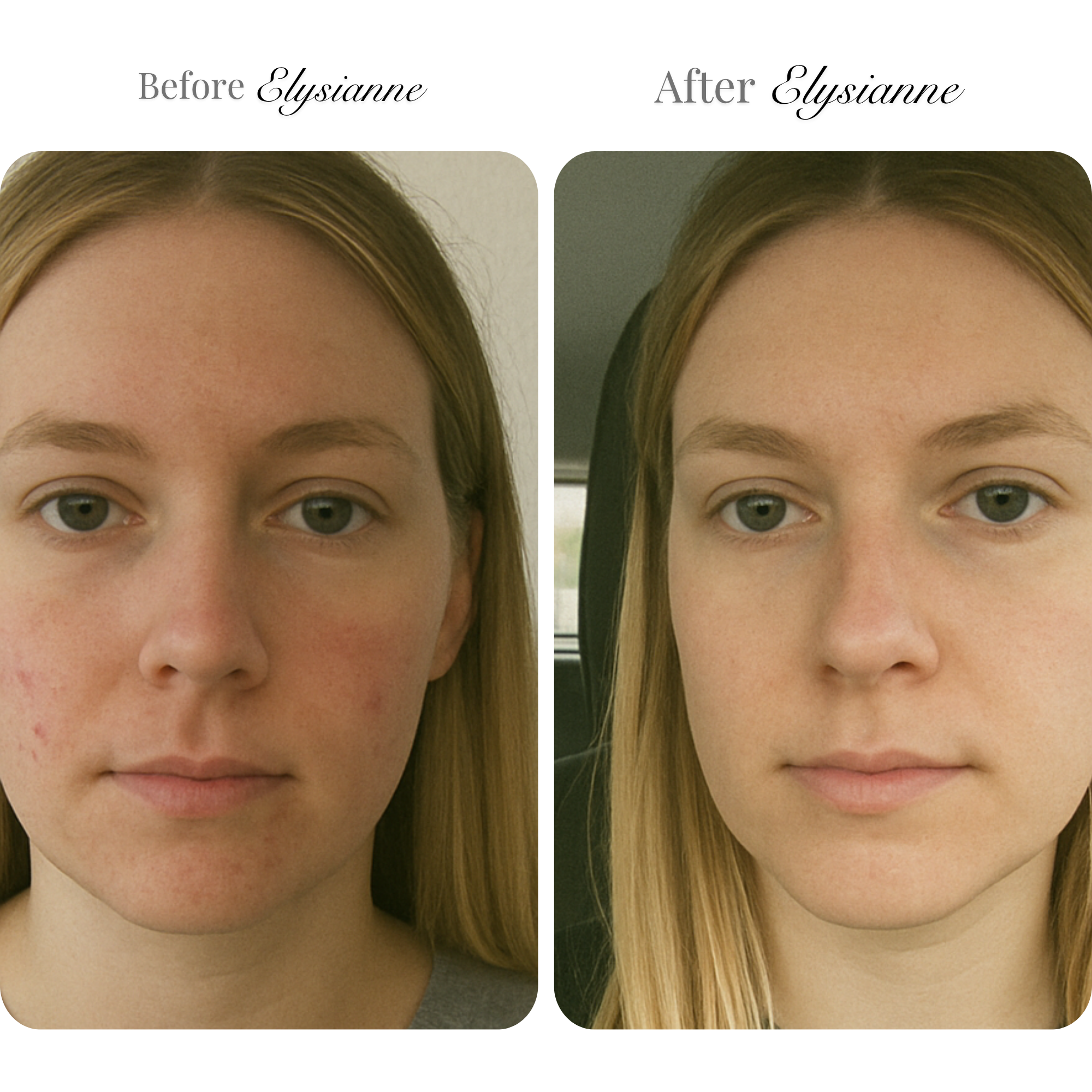 Microneedling Infusion Kit