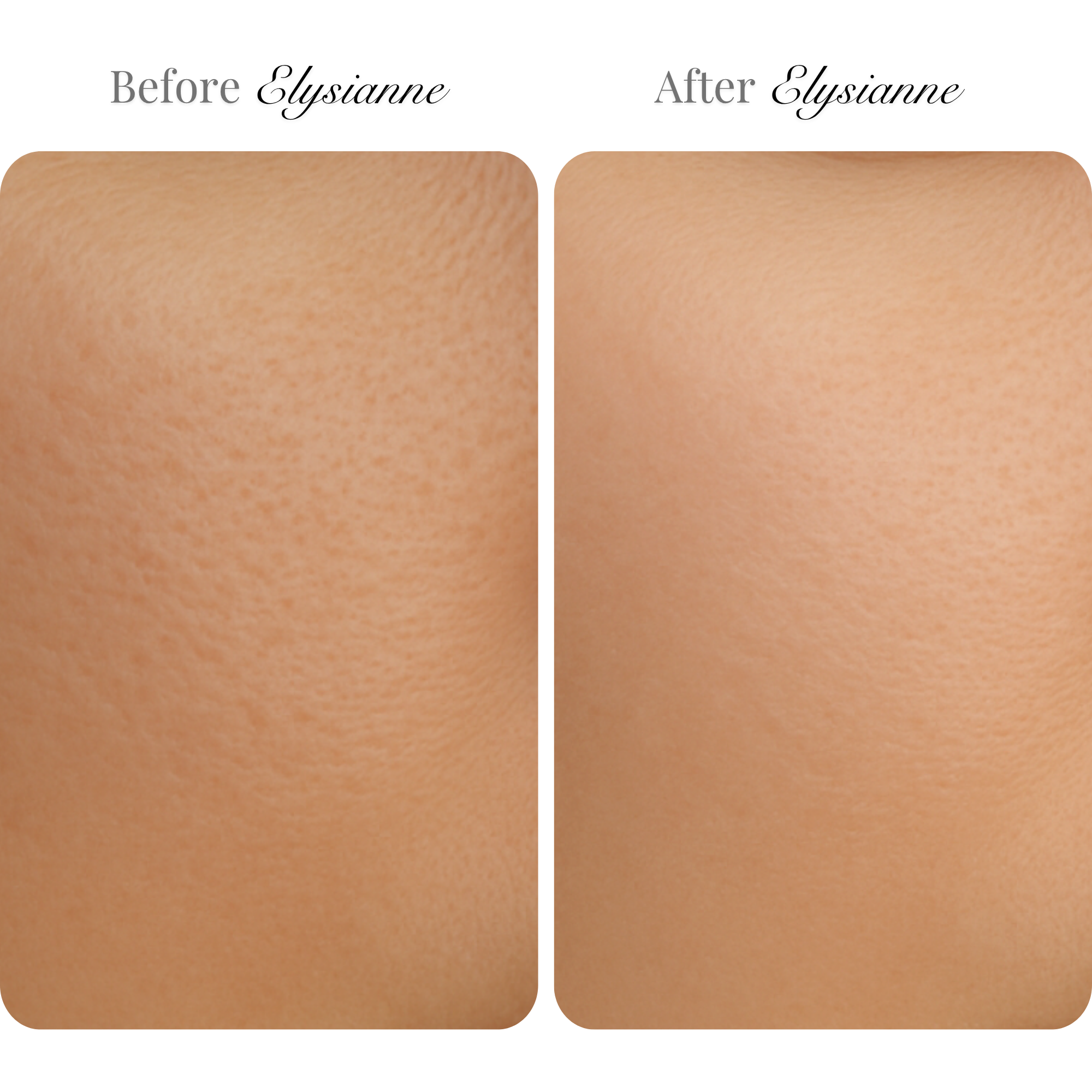 Microneedling Infusion Kit