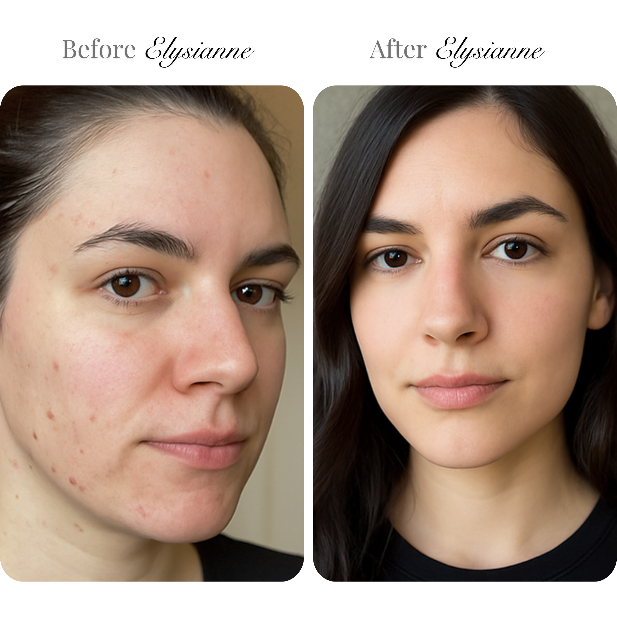 Microneedling Infusion Kit